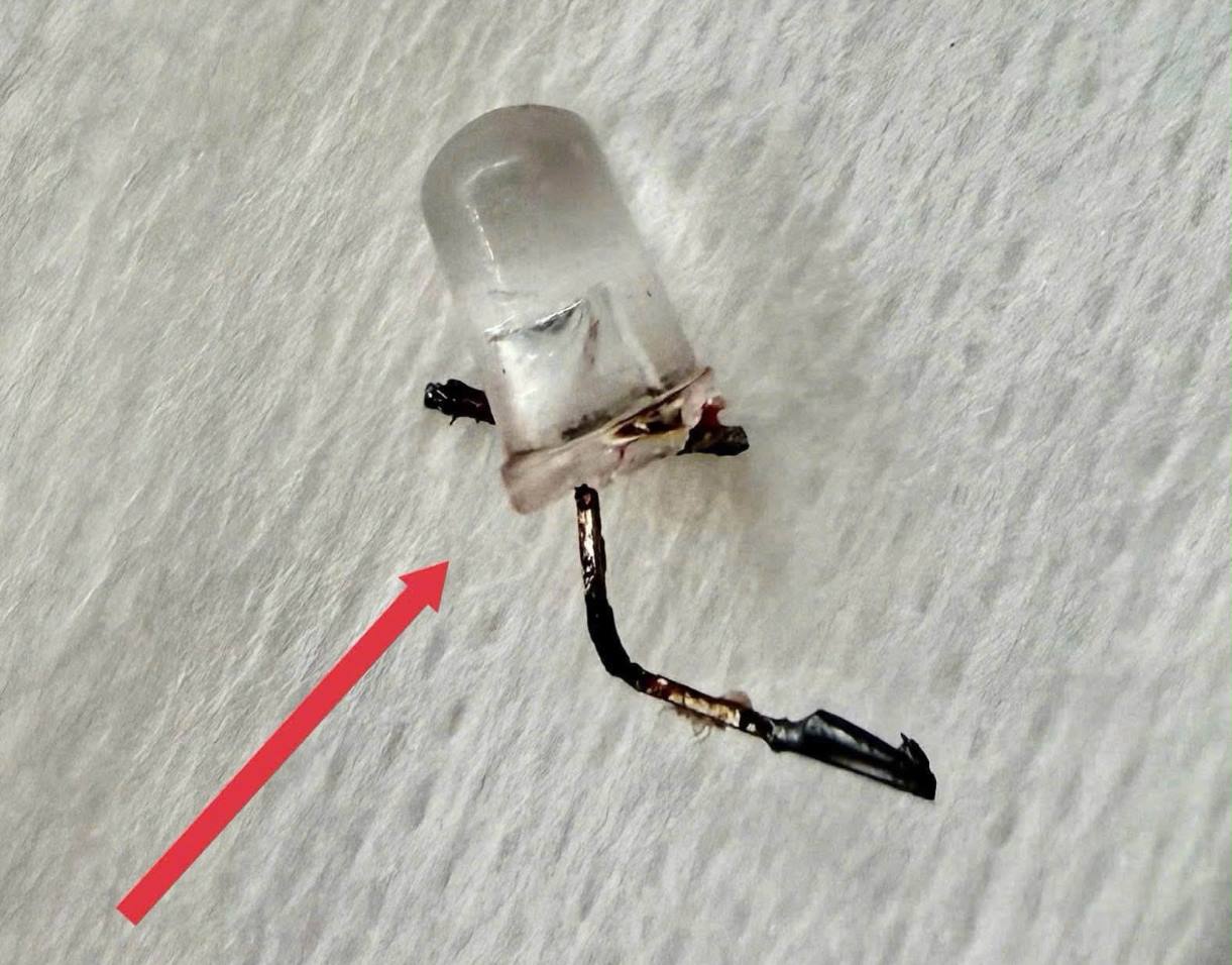 9-month-old infant choking on LED light bulbs into bronchi. Photo: Hospital provided