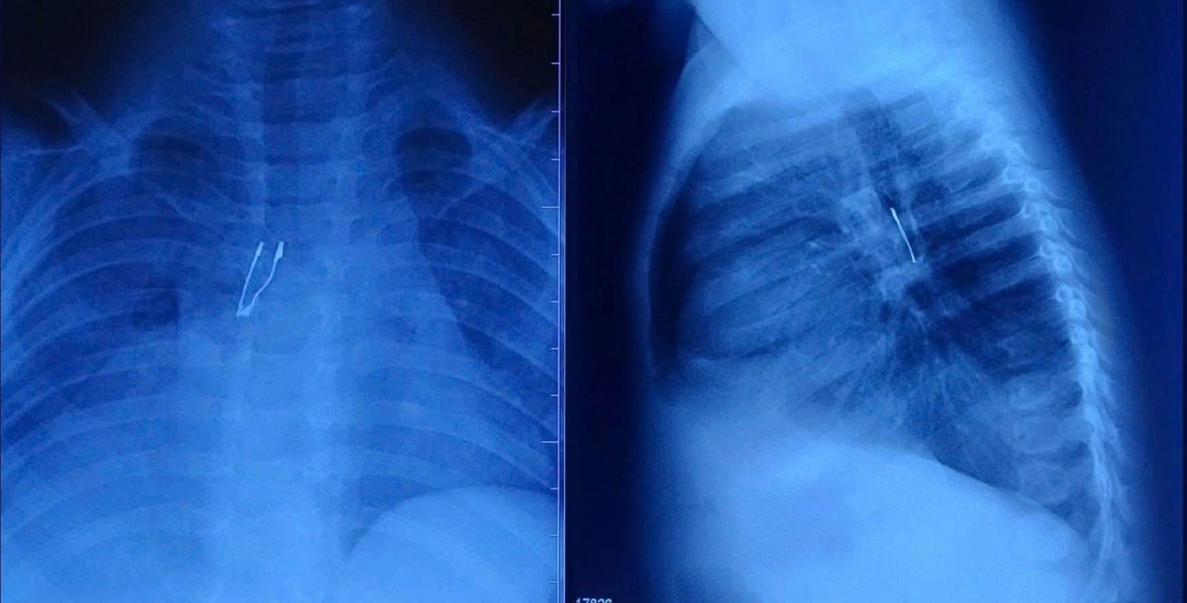 Hình ảnh X-quang. Ảnh: Bệnh viện cung cấp