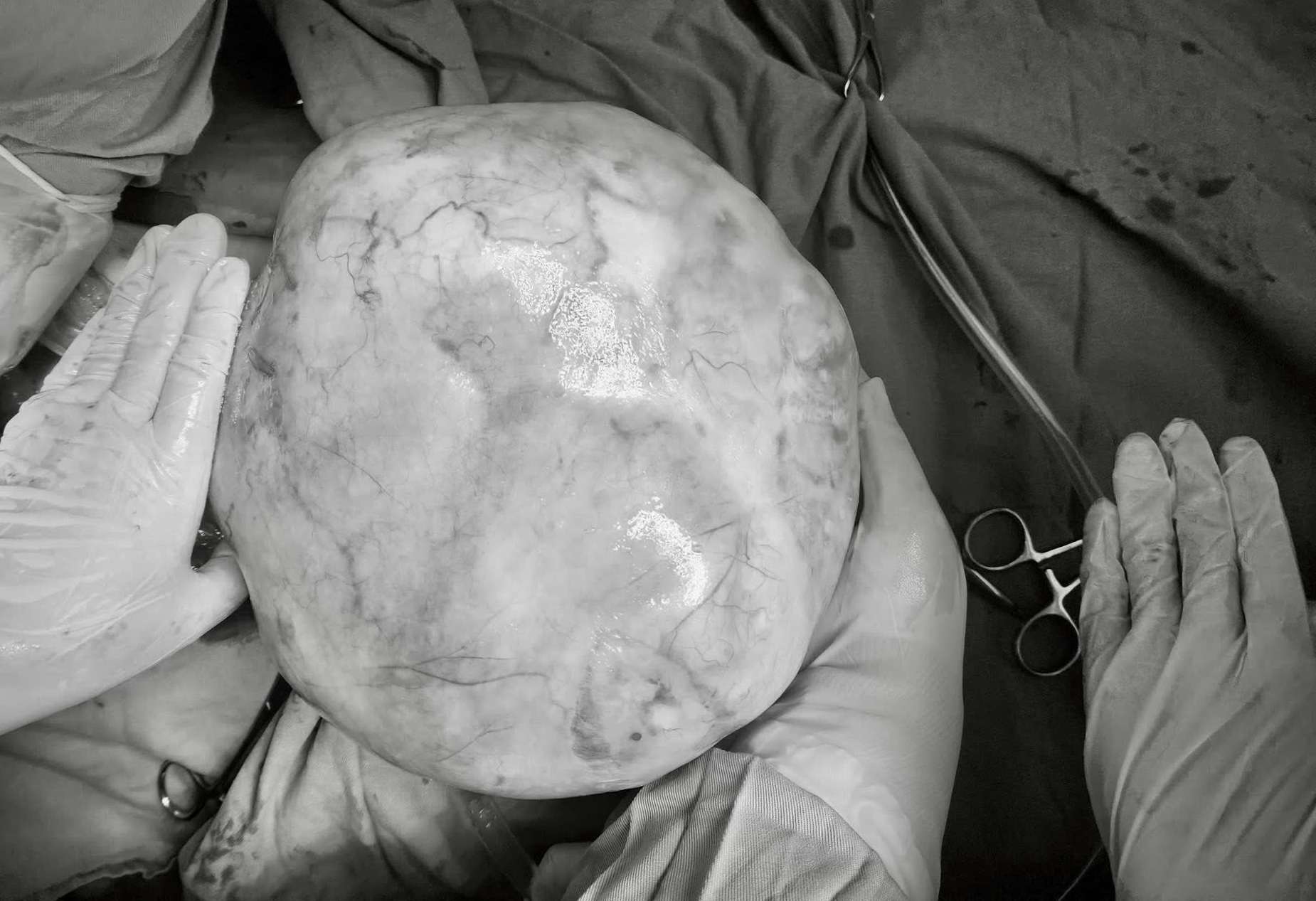 14歳の少女が4kg以上の卵巣腫瘍を患う。写真:BVCC