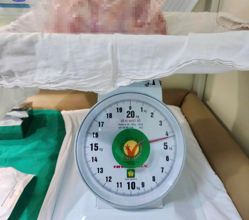Khối u buồng trứng nặng hơn 4kg. Ảnh: BVCC