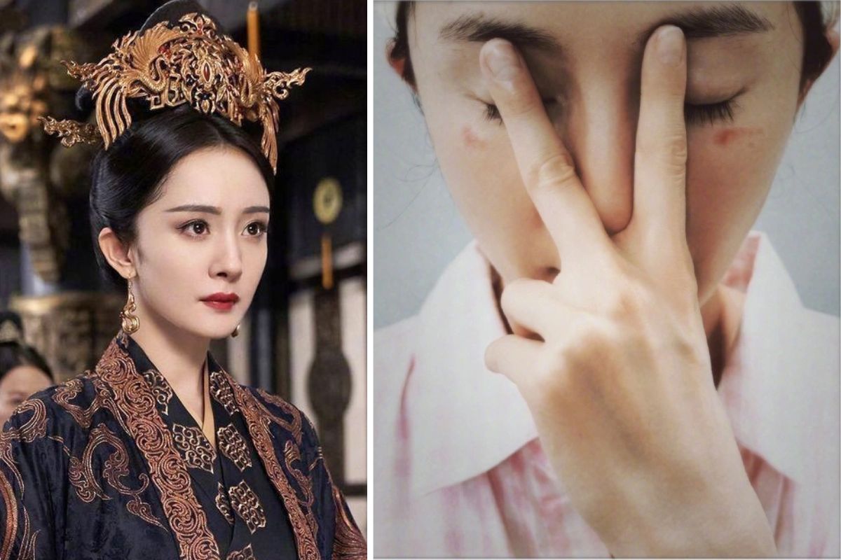 Dương Mịch bị bỏng do sử dụng