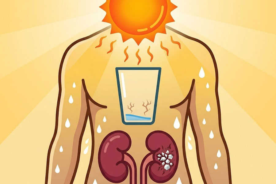 La chaleur peut augmenter le risque de calculs rénaux. Graphique: Thiện Nhân