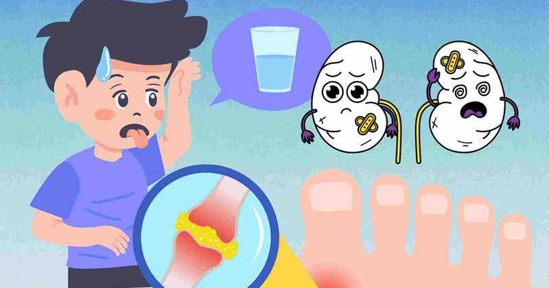 Uống ít nước làm tăng axit uric, tăng nguy cơ sỏi thận
