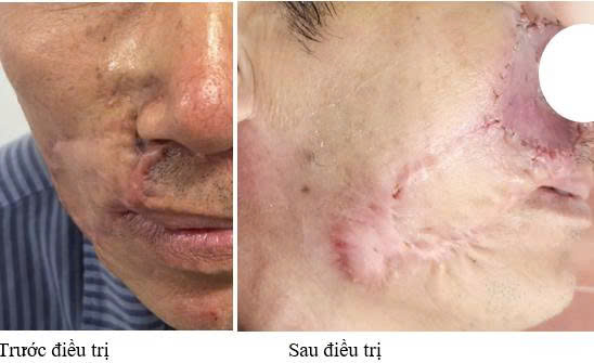 Image d'un patient atteint d'un carcinome basocellulaire avant et après le traitement. Photo: BVCC