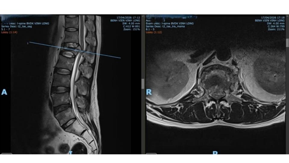 X-ray image of the spine before surgery of the patient. Photo: Hospital provided