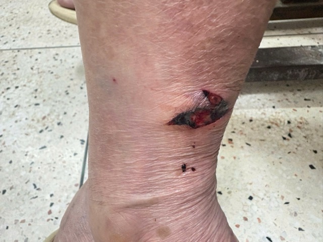 The patient's leg was bitten by a cat before, leading to swelling and pain, accompanied by mild fever. Photo: BVCC