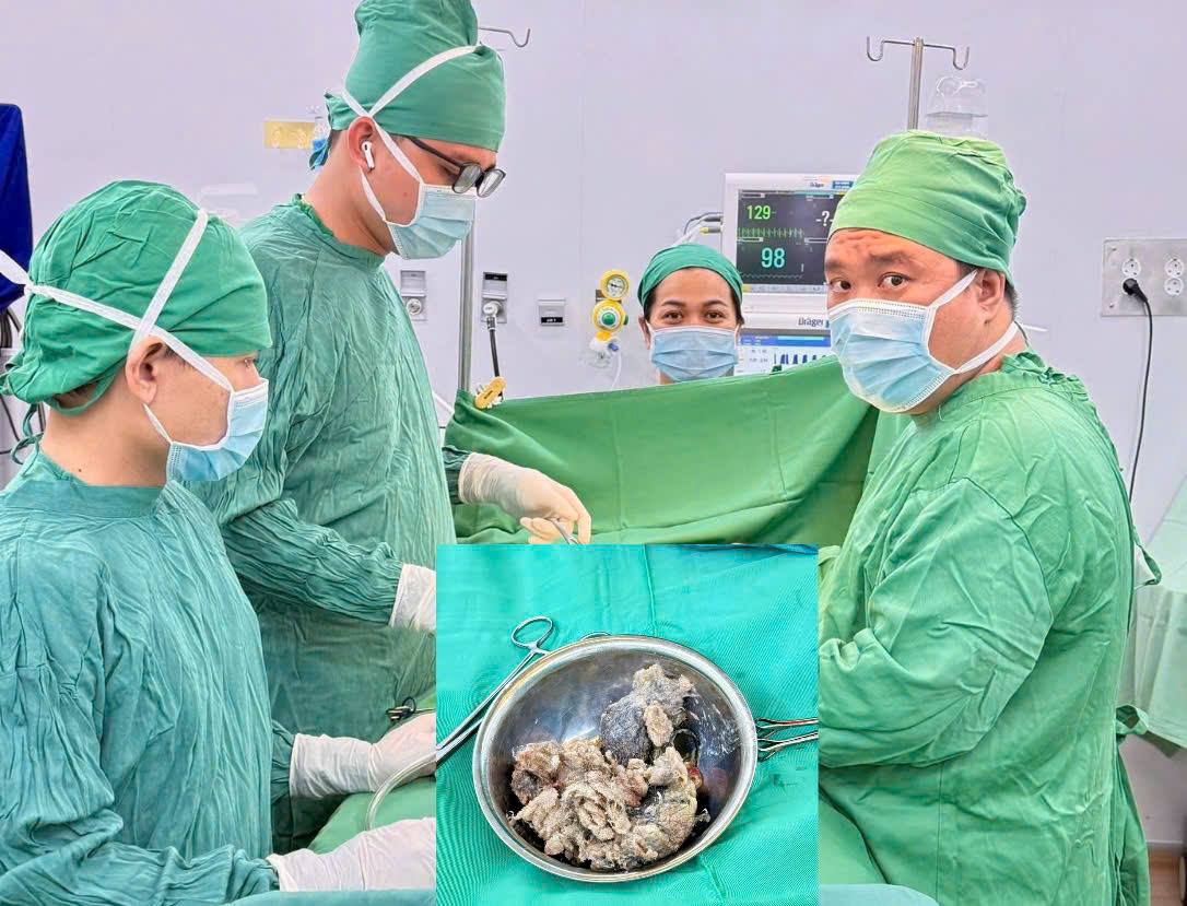 The baby had prolonged abdominal pain, after examination and surgery, the doctor removed a large bun and cotton ball from the stomach. Photo: Anh Thu