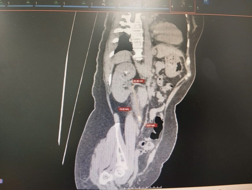 Ảnh CT trước khi mổ sỏi thận. Ảnh: BVCC
