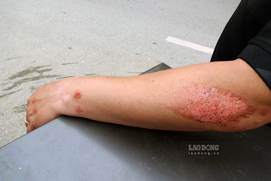 Sau khi ôtô đâm rào chắn, thanh sắt đã văng ra trúng 2 xe máy đang di chuyển ngoài làn hỗn hợp. Tài xế xe máy bị xây xát phần tay, chân.