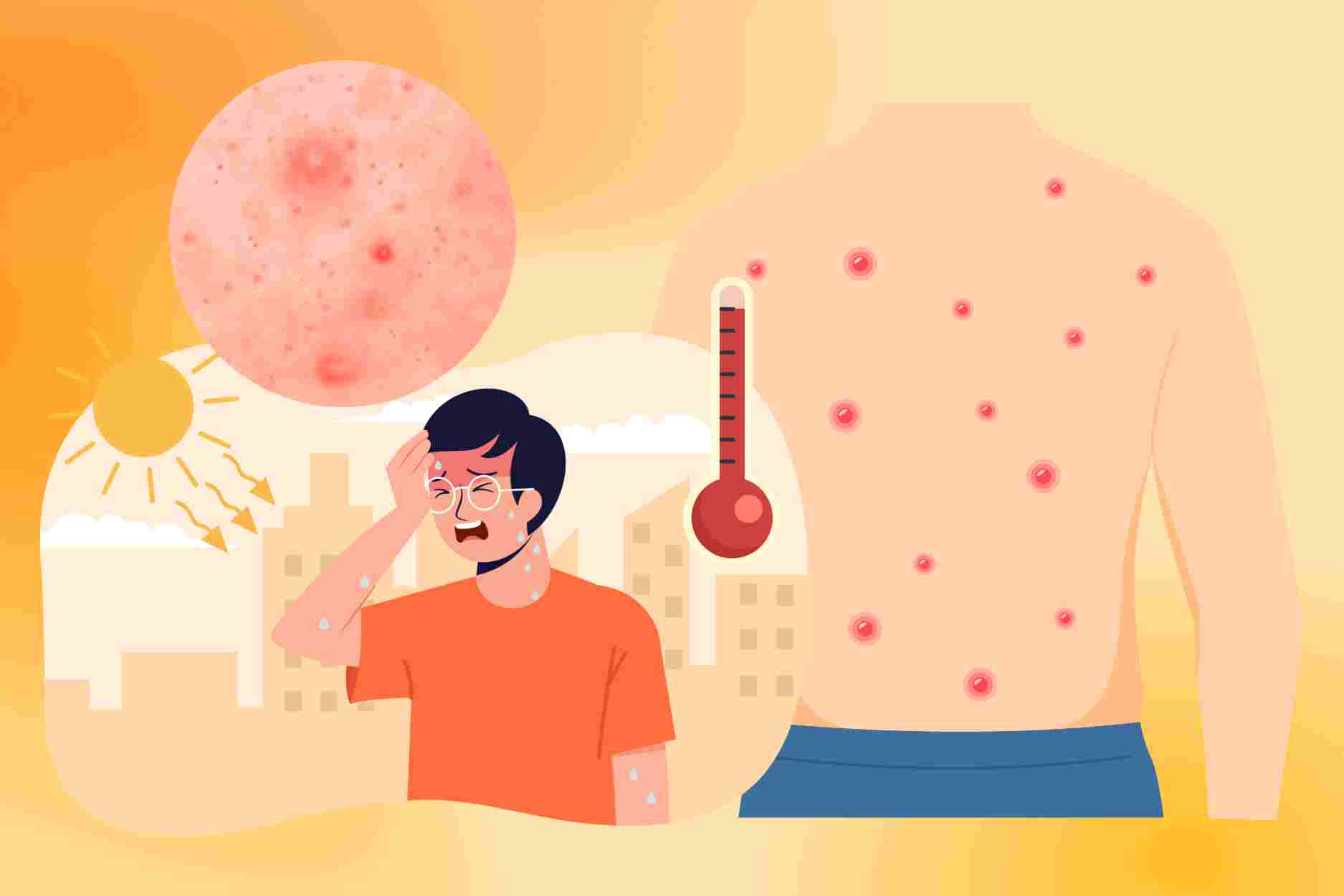 Summer back acne increases sharply due to habits that few people pay attention to