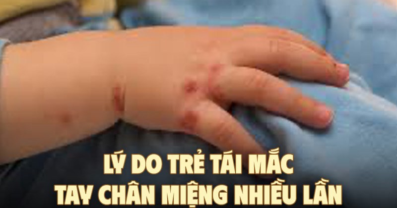 Vì sao trẻ mắc tay chân miệng nhiều lần?