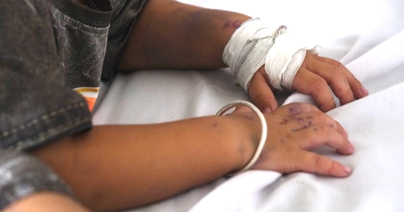 Aumento de la enfermedad de manos, pies y boca en los hospitales de último nivel del Delta del Mekong.