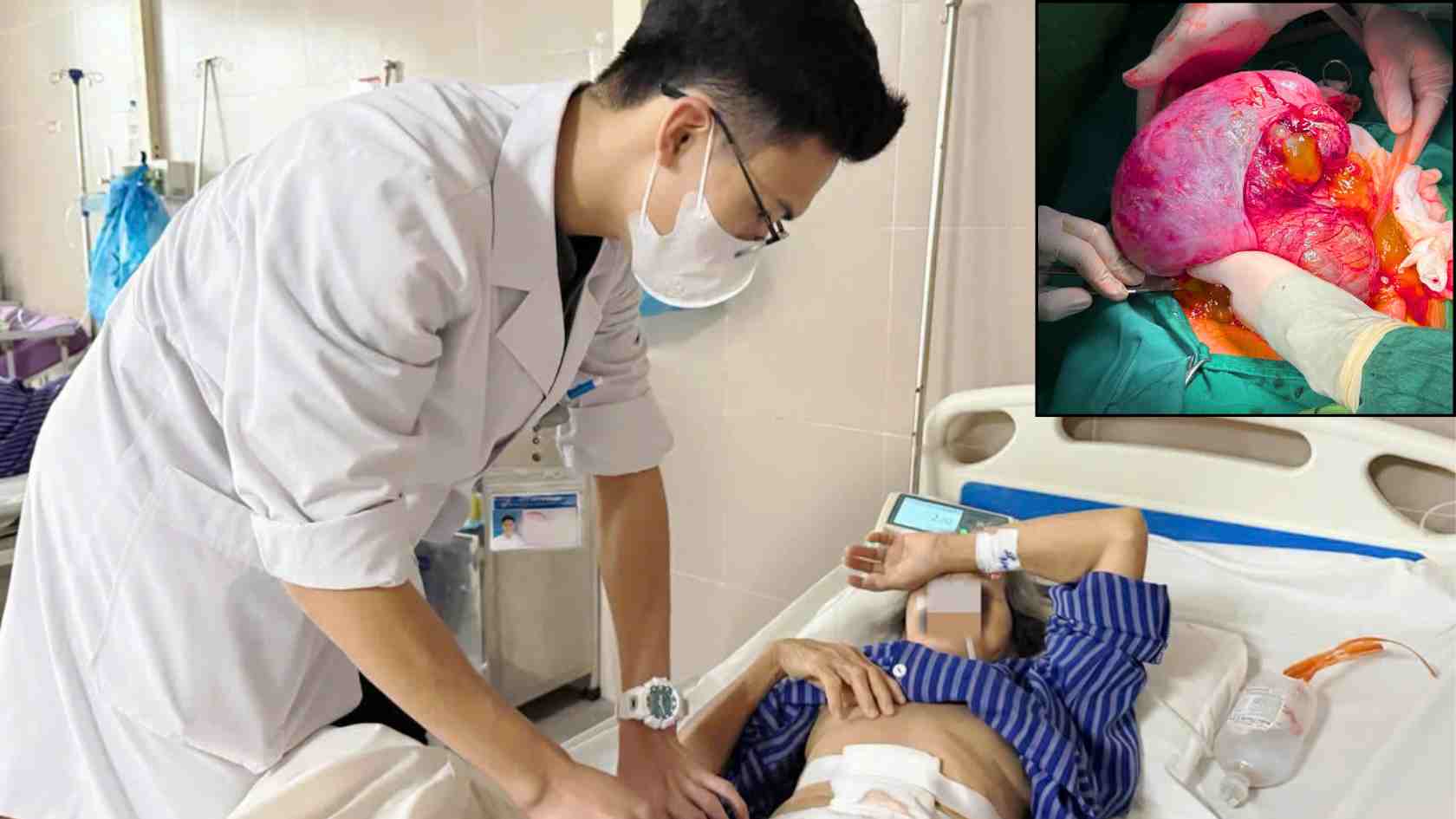 Una anciana de 78 años en Lang Son fue extirpada de un tumor que pesaba casi 6 kg. Foto: Hospital General de Lang Son