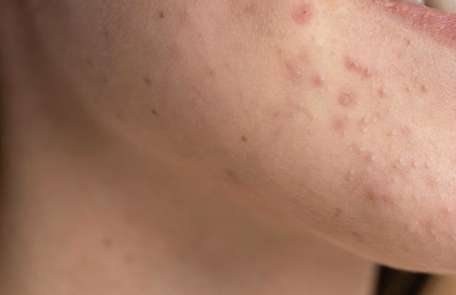Acne is not only caused by skin but is also closely related to digestion, stress and sleep of the body. Photo: Thuy Duong