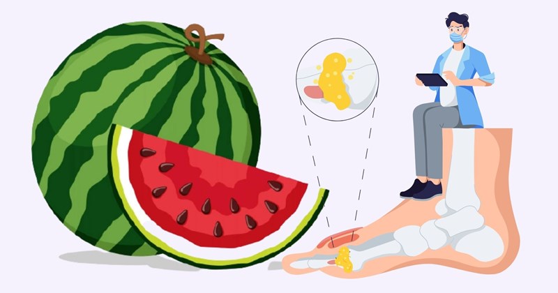 Hạ acid uric mùa hè: Bí quyết từ trái cây