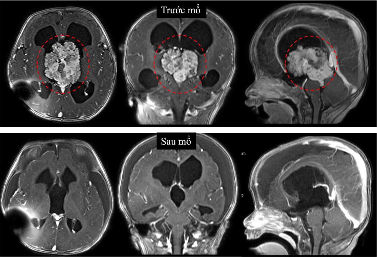 Doctors have successfully treated a 7-month-old infant with a large brain tumor. Photo: Hospital provided
