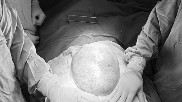 The patient's tumor was removed by surgery. Photo: BVCC
