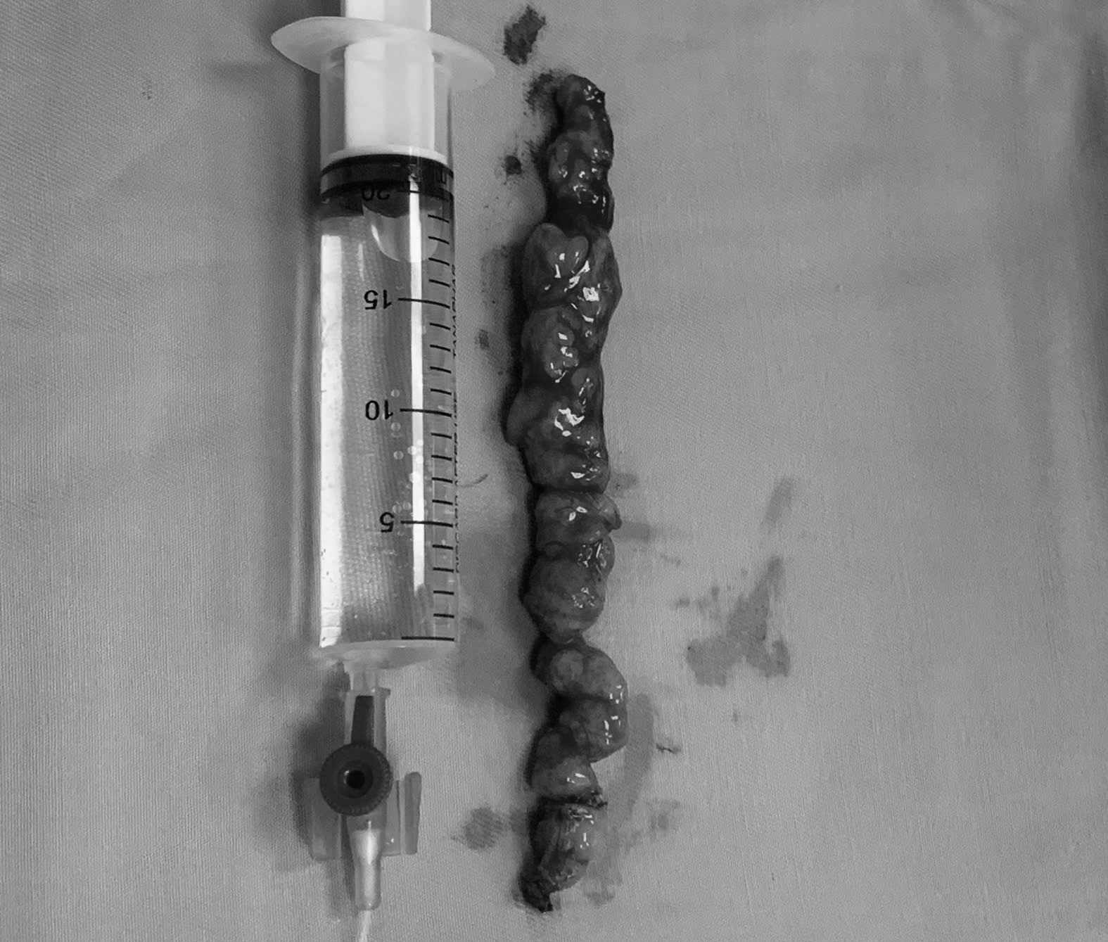 Los médicos operan para extirpar un tumor complejo de médula espinal lumbar, que se extiende unos 15 cm desde la zona lumbar hasta casi el extremo agujero para un paciente con cáncer. Foto: Tran Ha