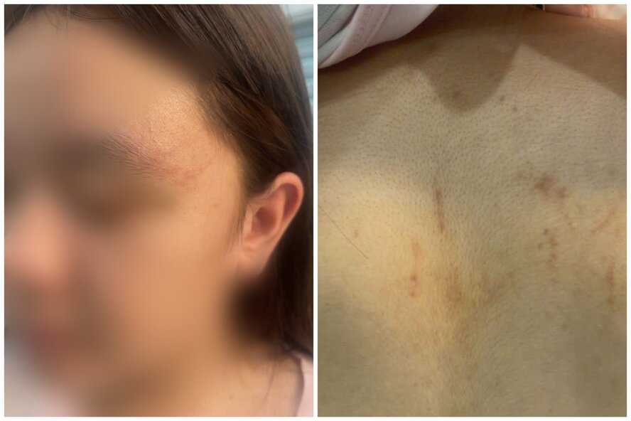 Một số vết xước, tím trên mặt và lưng của em H.A. Ảnh: GĐCC