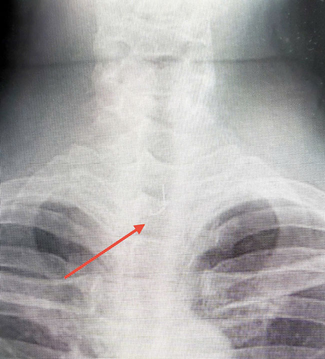 Kết quả chụp X-quang và CT Scan ghi nhận dị vật nằm ngang thực quản. Ảnh: BVĐN