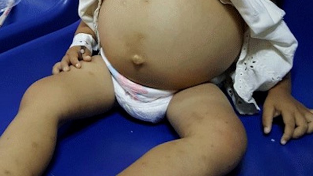 Patients with severe Thalassemia (congenital thalassemia), spleen and liver enlargement complications... Photo: BSCC