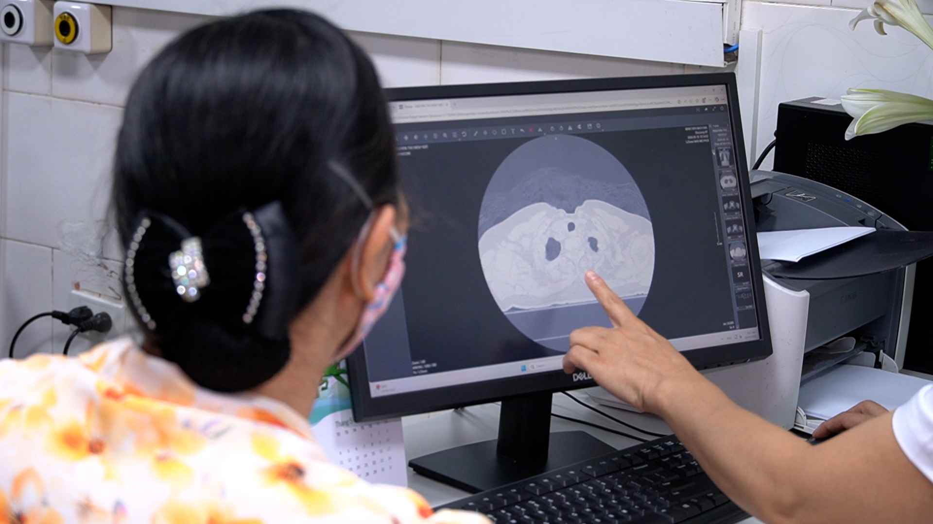 Chest tightness, shortness of breath, many people worry about going for lung cancer screening.