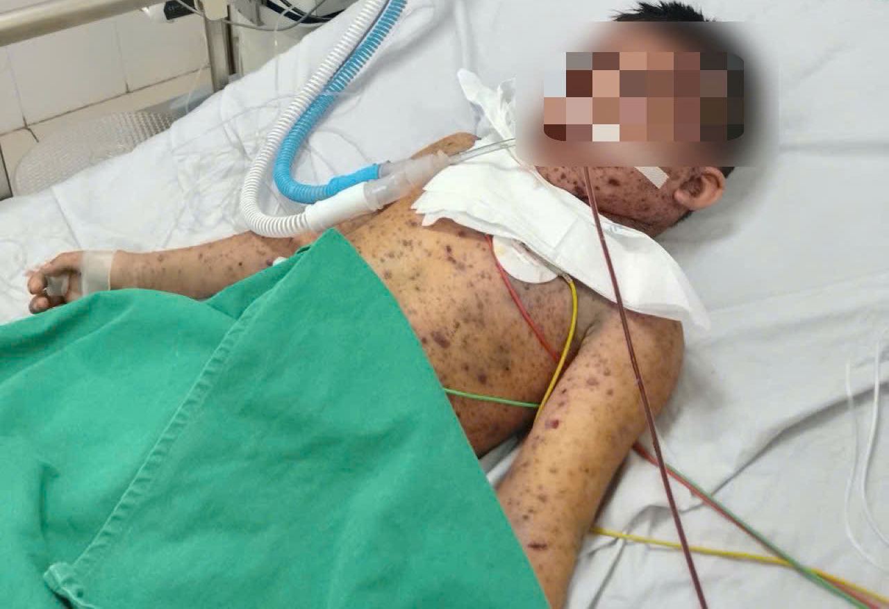 Baby boy in critical condition from a few chickenpox spots. Photo: Thanh Dang