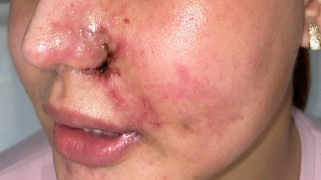 Patients have complications from injecting fillers into the nose and cheeks for beauty. Photo: Nguyen Ly