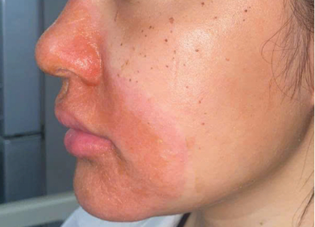Peeling skin at spa, young girl hospitalized due to severe contact dermatitis. Photo: BVCC