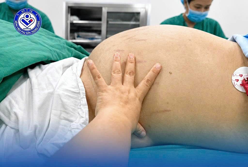 Thinking she had a belly fat, a 19-year-old girl carried a tumor containing 10 liters of fluid. Photo: BVCC
