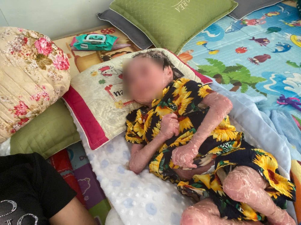 Cơ thể bé Phong luôn trong tình trạng nứt nẻ, bong tróc và đau rát. Ảnh: Gia đình cung cấp