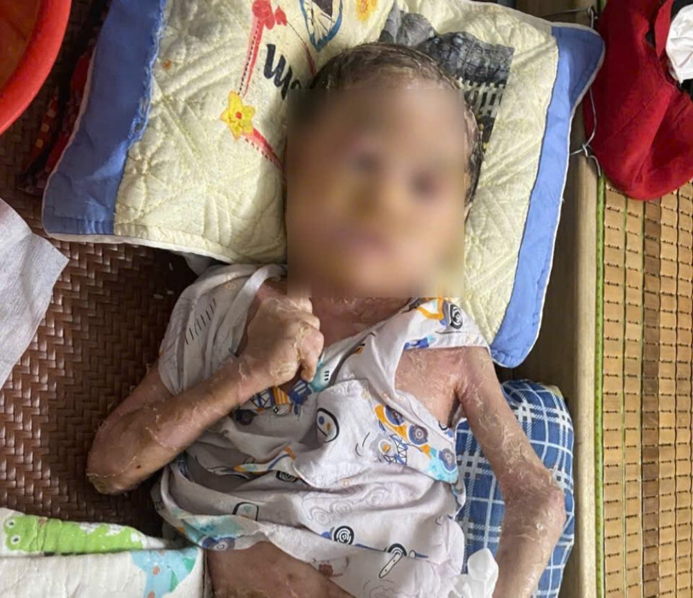 Bé Đặng Nhật Phong phải chịu cảnh da bong tróc, nứt nẻ khắp cơ thể... Ảnh: Gia đình cung cấp