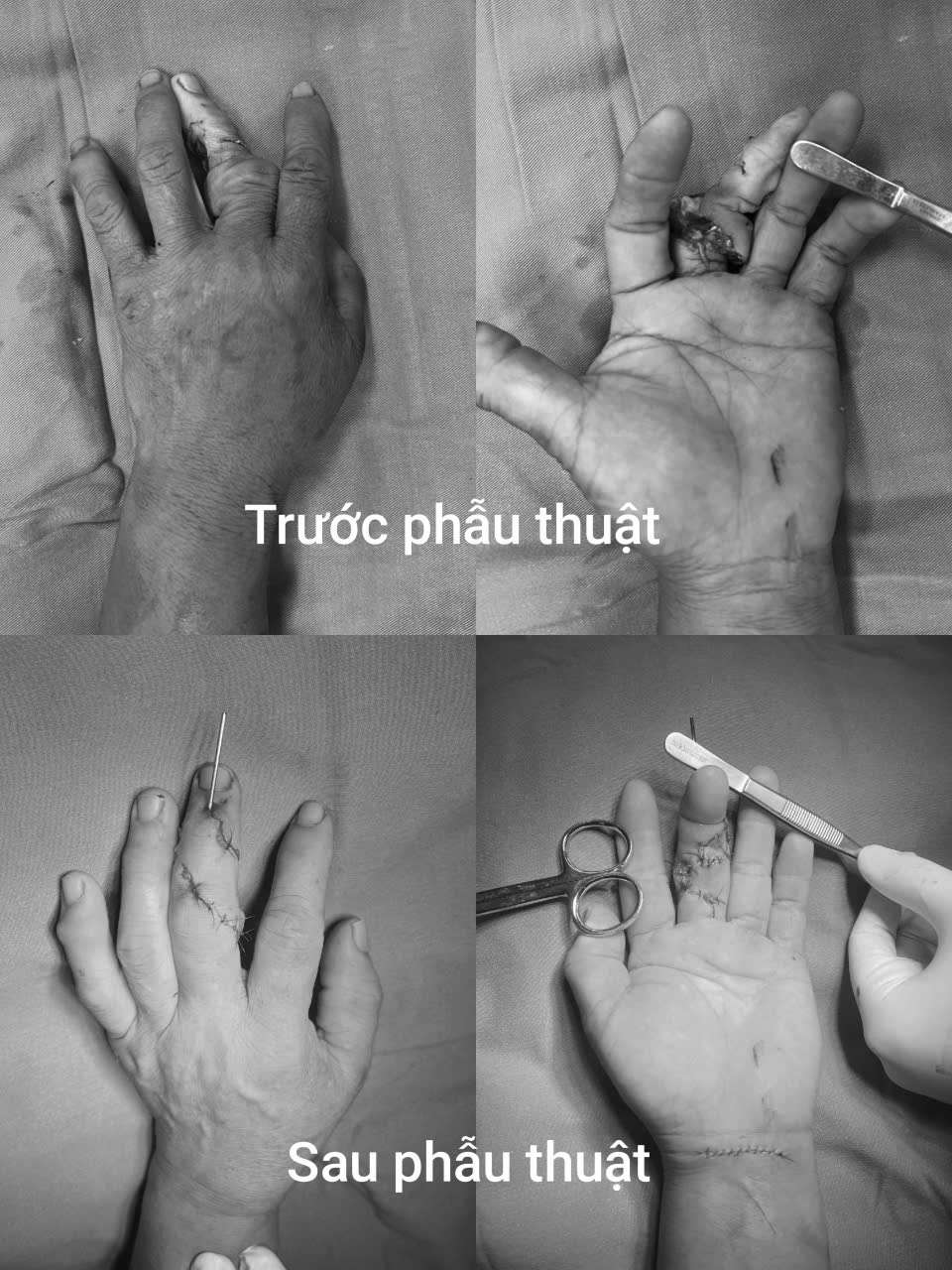Ngón tay nạn nhân trước và sau phẫu thuật. Ảnh: BVCC
