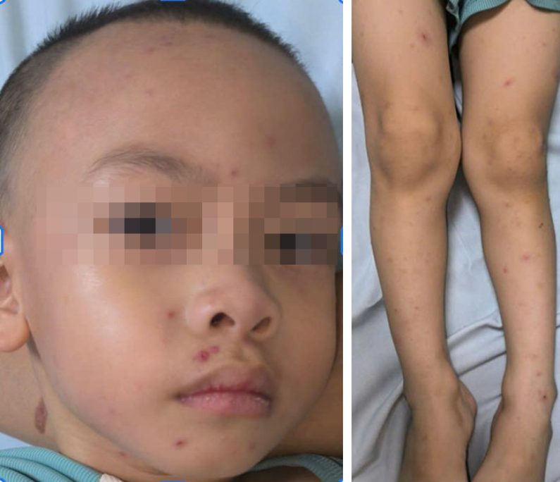 Lesions of concave blisters in the middle are evenly scattered throughout the head, face, and legs due to chickenpox. Photo: BVCC