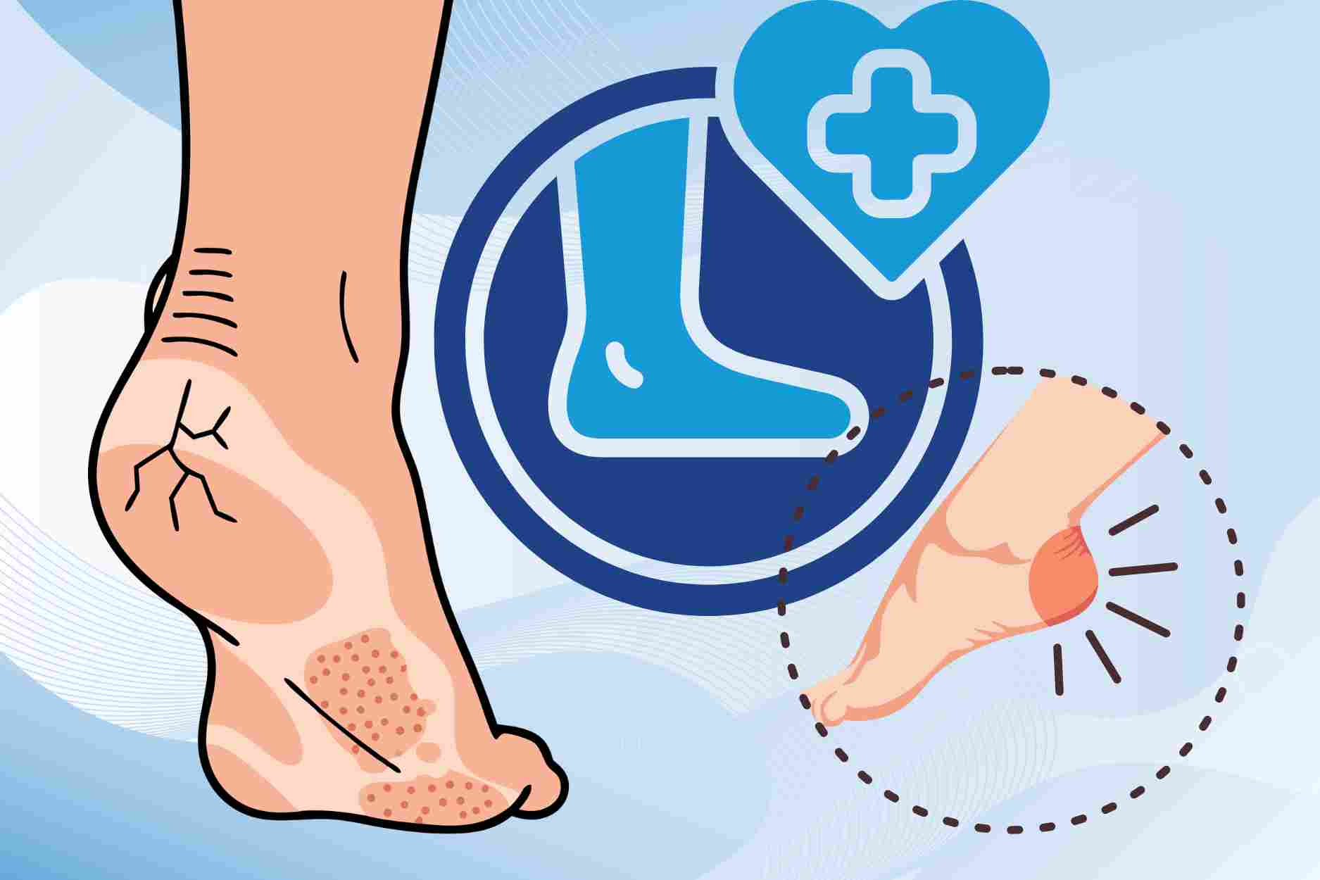 Ways to prevent heel cracks that should not be ignored