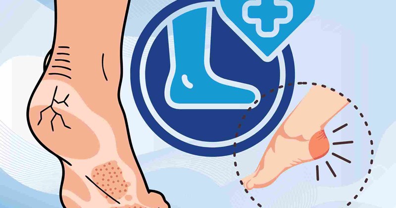 Cách ngăn ngừa nứt gót chân không nên bỏ qua