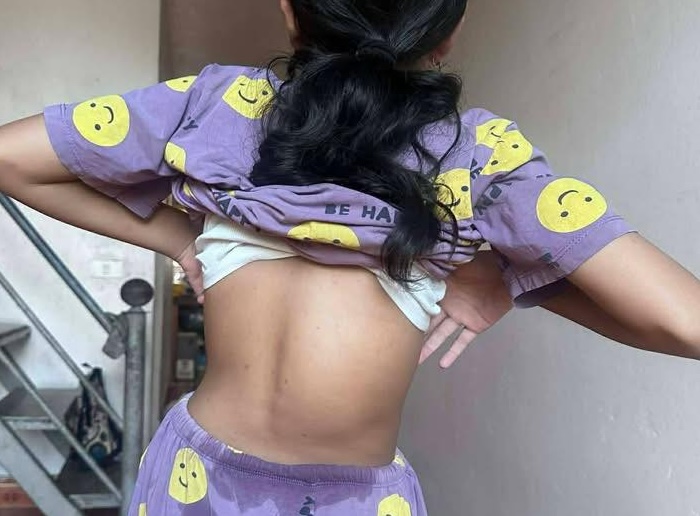 Kim Ngân cần được phẫu thuật sớm để tránh những biến chứng do vẹo cột sống gây ra.