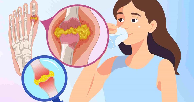 Tác động của việc uống ít nước đến người có axit uric cao