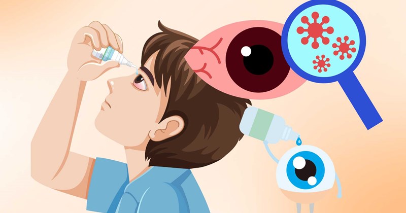 Viêm kết mạc dị ứng: Điều người bệnh cần lưu ý