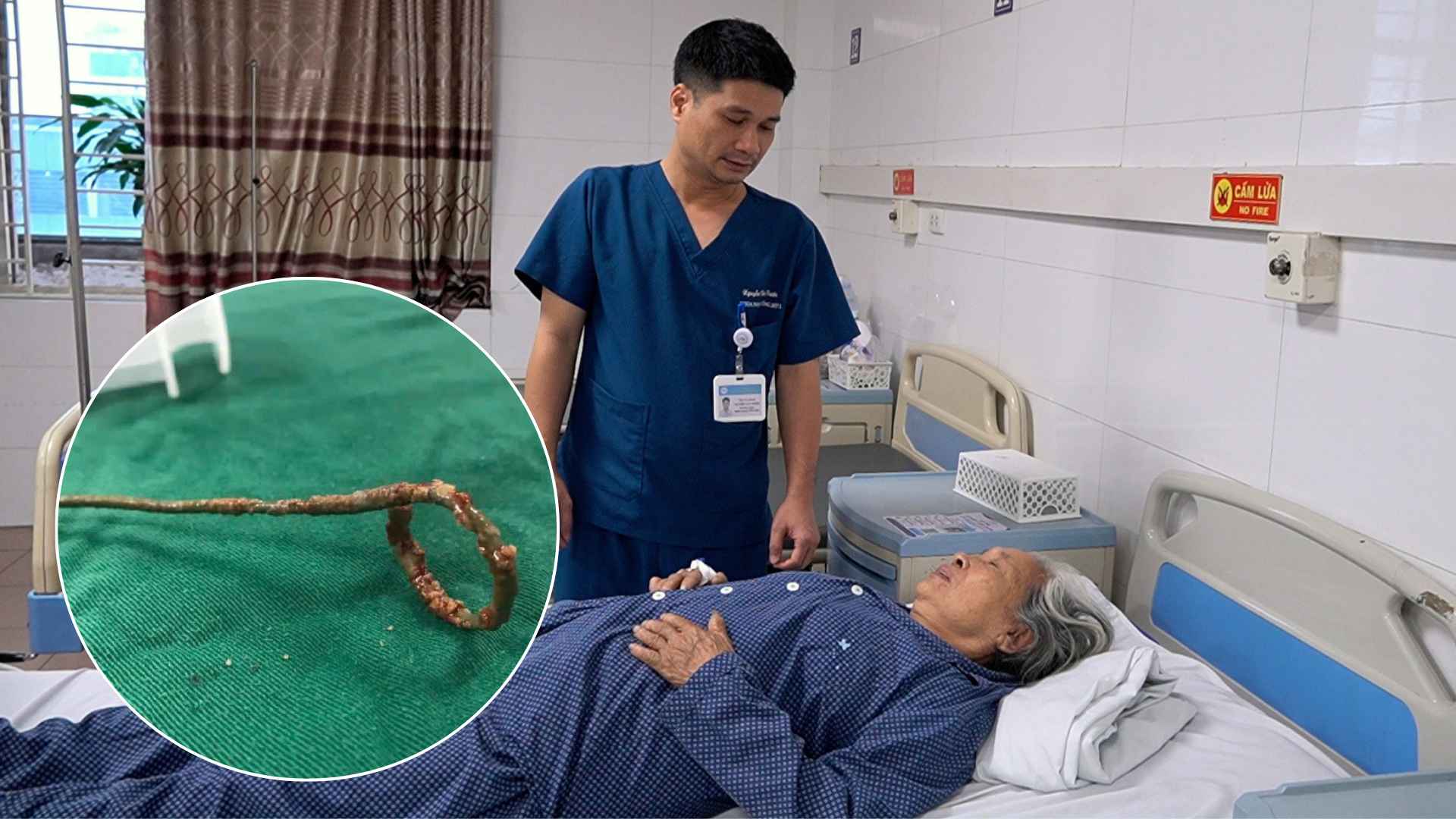 Descubren una sonda uretral "olvidada" 22 años después de la cirugía de cálculos renales.
