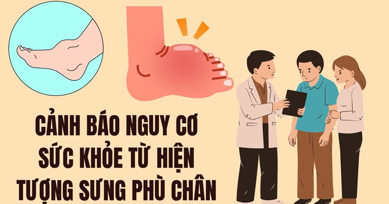 Cảnh báo rủi ro sức khỏe từ hiện tượng sưng phù chân