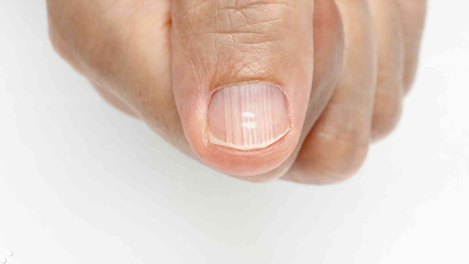 Fingernails with small white lines on the nail that last may be related to zinc, protein deficiency or nutritional disorders. Photo: Quang Minh