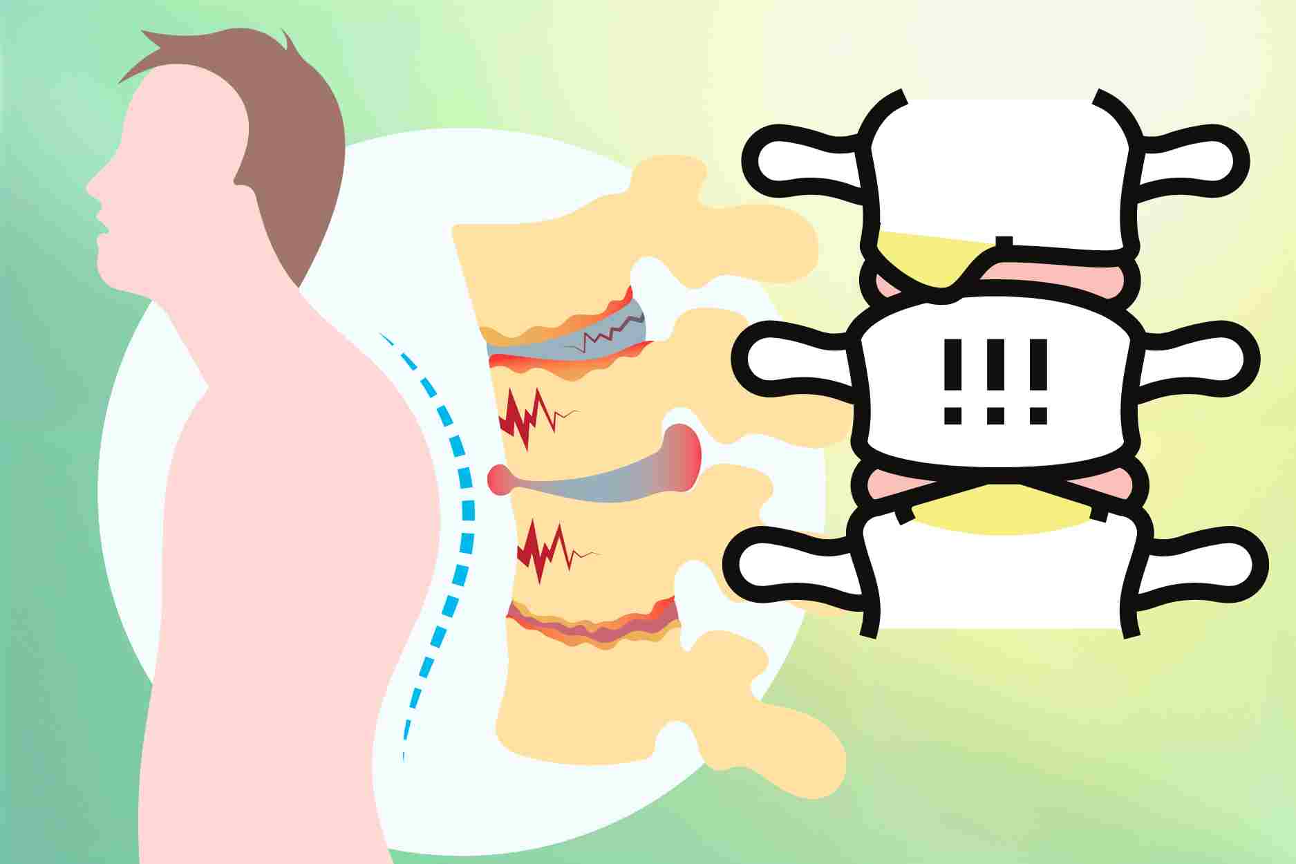 Effective ways to control joint spondylitis