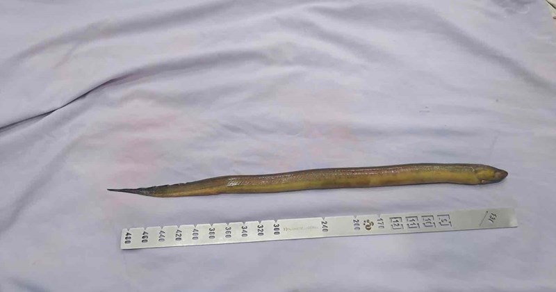Bệnh viện phẫu thuật lấy lươn dài 50cm trong bụng bệnh nhân