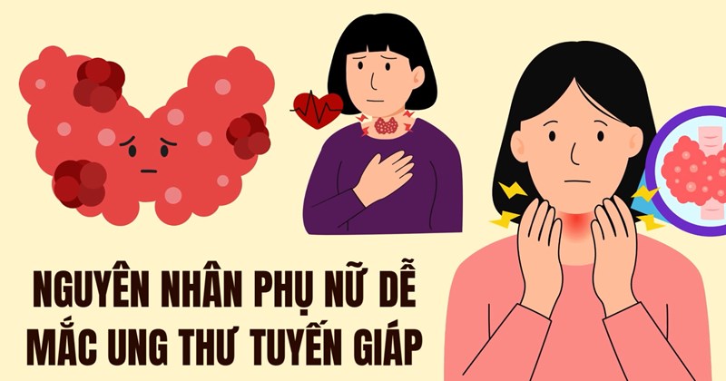 Vì sao phụ nữ dễ mắc ung thư tuyến giáp