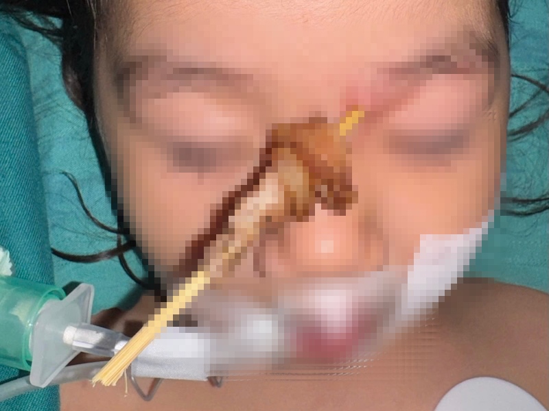 Bệnh nhi bị que xiên thịt nướng đâm