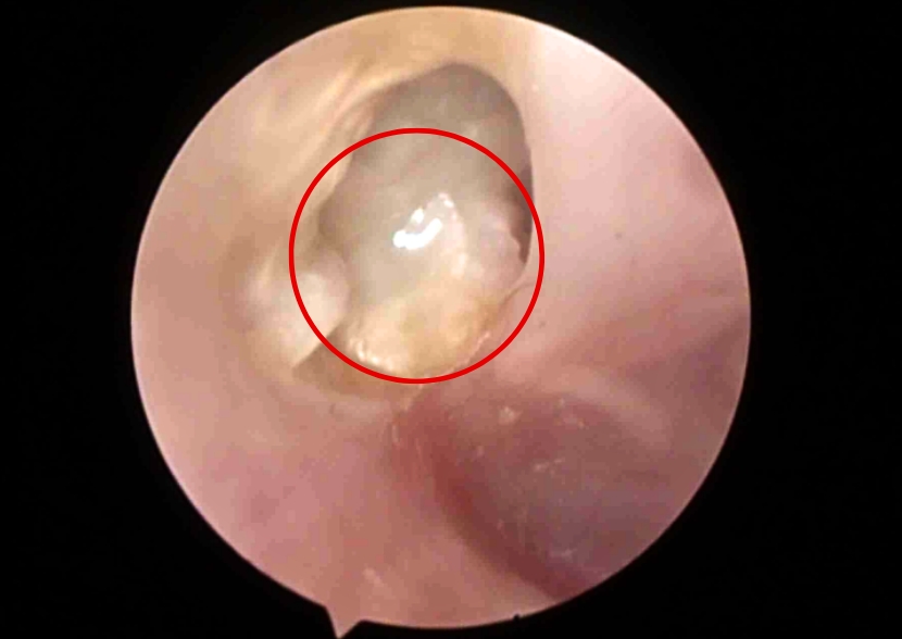 Khối cholesteatoma ăn mòn trong tai trái của bệnh nhân. Ảnh: BVCC
