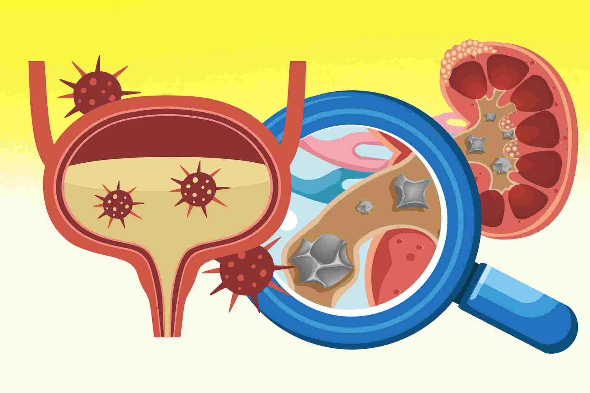 Summer habits that easily cause urinary tract infections and kidney stones