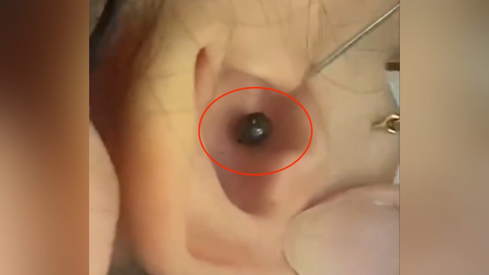 Dog ticks nest in the ear of a 7-year-old child in Quang Tri. Photo: Quang Ninh Regional General Hospital