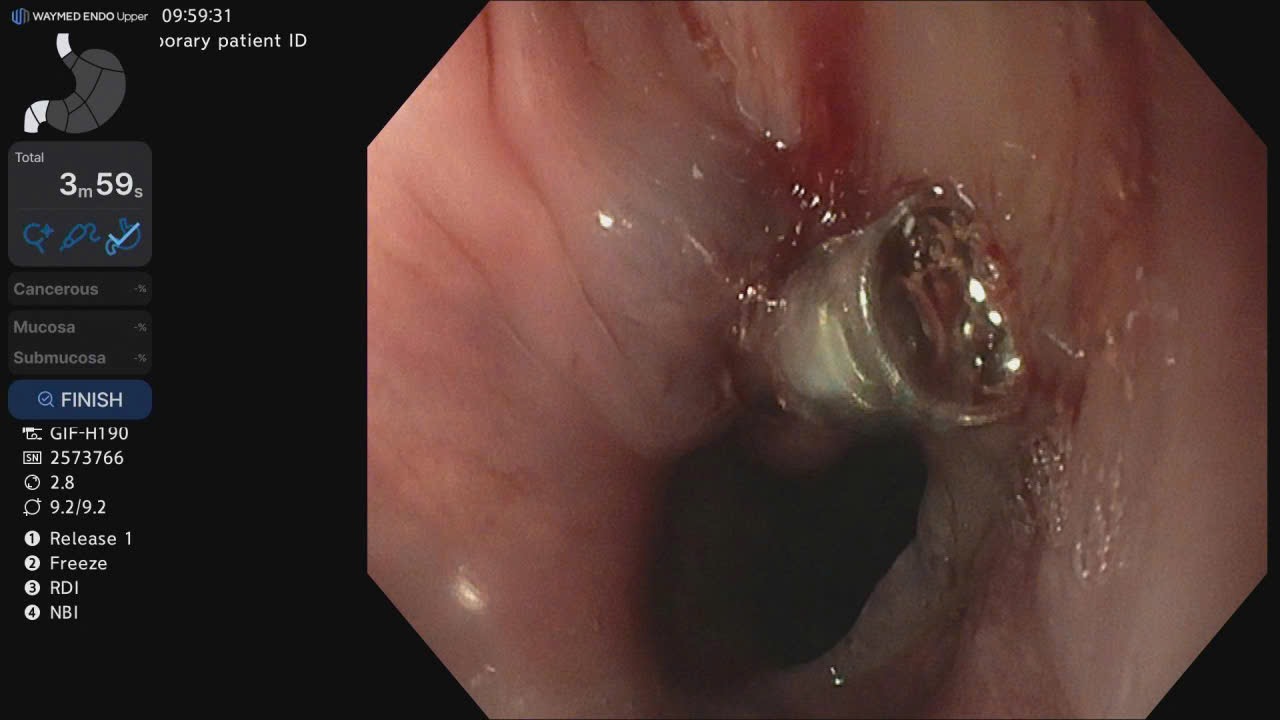 Female patient in Quang Tri has a duck bone piercing the esophagus. Photo: Vietnam - Cuba Friendship Hospital Dong Hoi